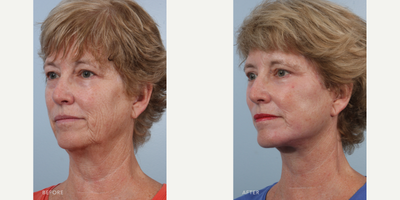 Chemical Peel before and after photo