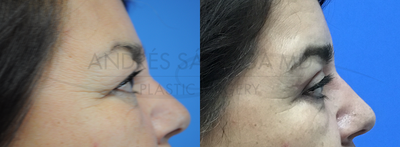 Eyelid Surgery before and after photo