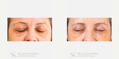 Eyelid Surgery before and after photo