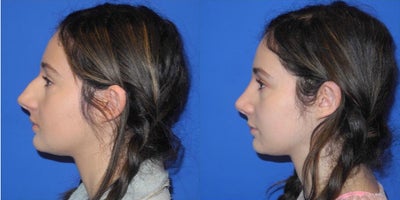 Rhinoplasty before and after photo