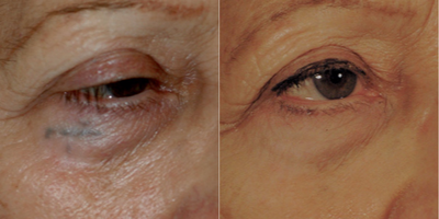 Tattoo Removal before and after photo