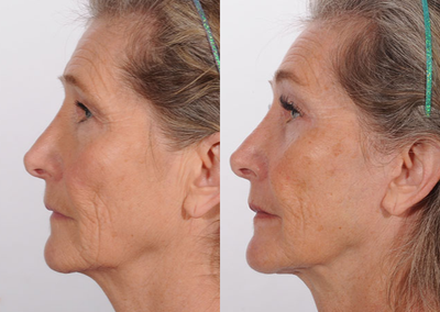 Breast Augmentation before and after photo
