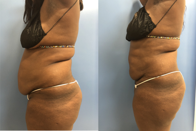 CoolSculpting before and after photo