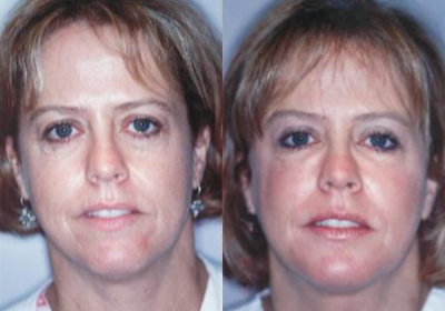 FaceTite before and after photo