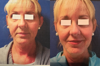 Restylane Lyft before and after photo