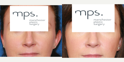 Rhinoplasty before and after photo