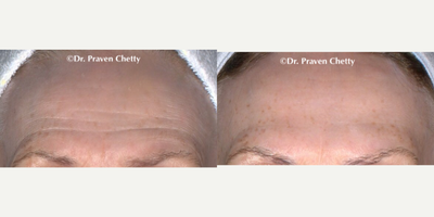 Botox before and after photo