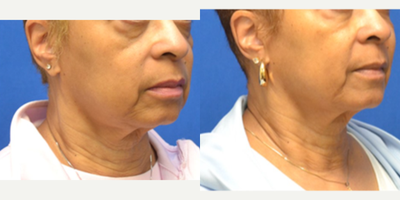 Dermal Fillers before and after photo