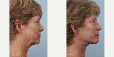 Facelift before and after photo