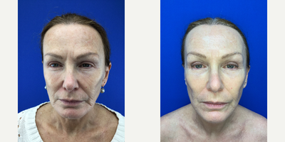 Halo Laser before and after photo