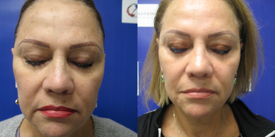 IPL before and after photo