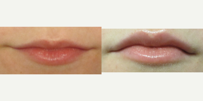 Lip Fillers before and after photo