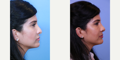 Revision Rhinoplasty before and after photo