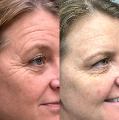 Botox before and after photo