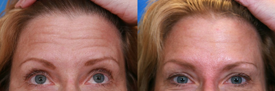 Botox before and after photo
