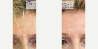 Botox before and after photo