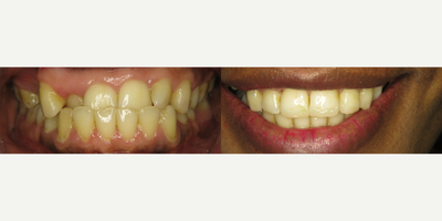 Braces before and after photo