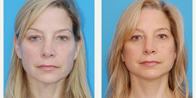 Facelift before and after photo