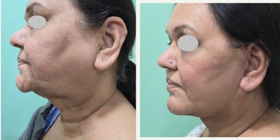 Facelift before and after photo