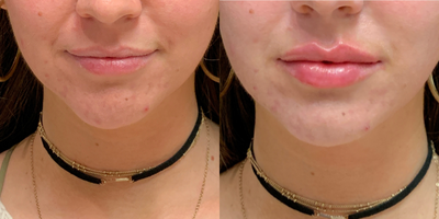 Lip Fillers before and after photo