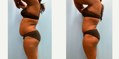 Tummy Tuck before and after photo