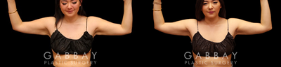 Arm Lift before and after photo