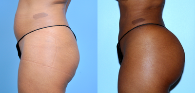 Brazilian Butt Lift before and after photo
