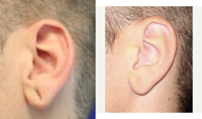 Earlobe Repair before and after photo