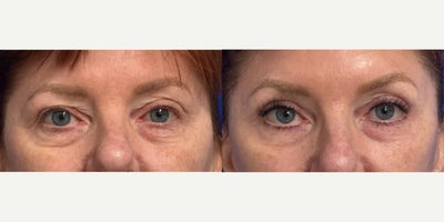 Eyelid Surgery before and after photo