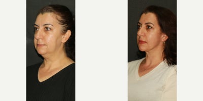 Facelift before and after photo