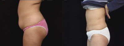 Liposculpture before and after photo