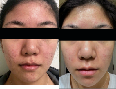 Microneedling before and after photo