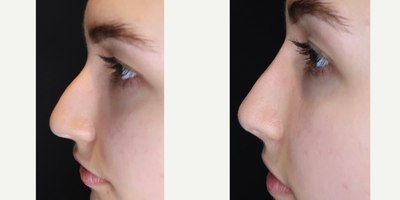 Nonsurgical Nose Job before and after photo