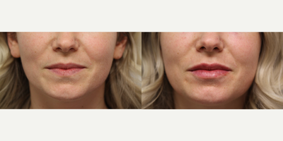 Restylane before and after photo