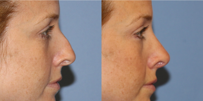 Rhinoplasty before and after photo