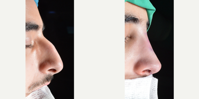 Rhinoplasty before and after photo