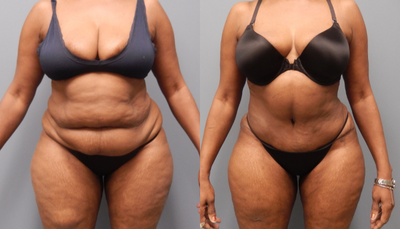 Tummy Tuck before and after photo