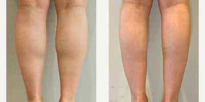 Botox before and after photo