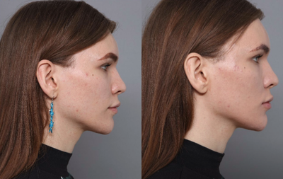 Dermal Fillers before and after photo
