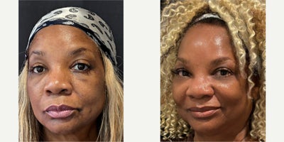 HydraFacial before and after photo
