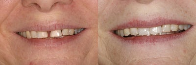 Invisalign before and after photo