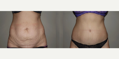 Tummy Tuck Revision before and after photo