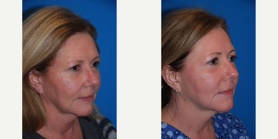 Chemical Peel before and after photo
