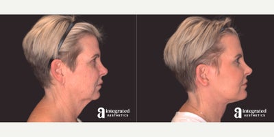 Facelift before and after photo