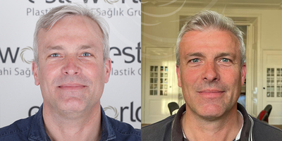 Hair Loss Treatment before and after photo