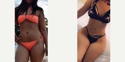 Liposculpture before and after photo