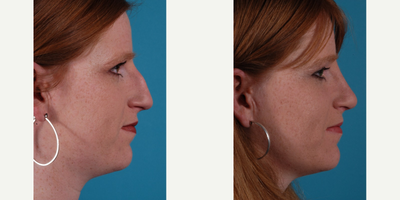 Rhinoplasty before and after photo