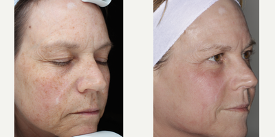 Skin Rejuvenation before and after photo
