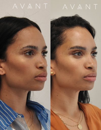 Thread Lift before and after photo