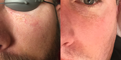 Vbeam before and after photo